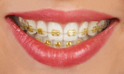 lingual braces