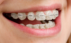 Types of Braces, Metal, Ceramic & Gold Braces