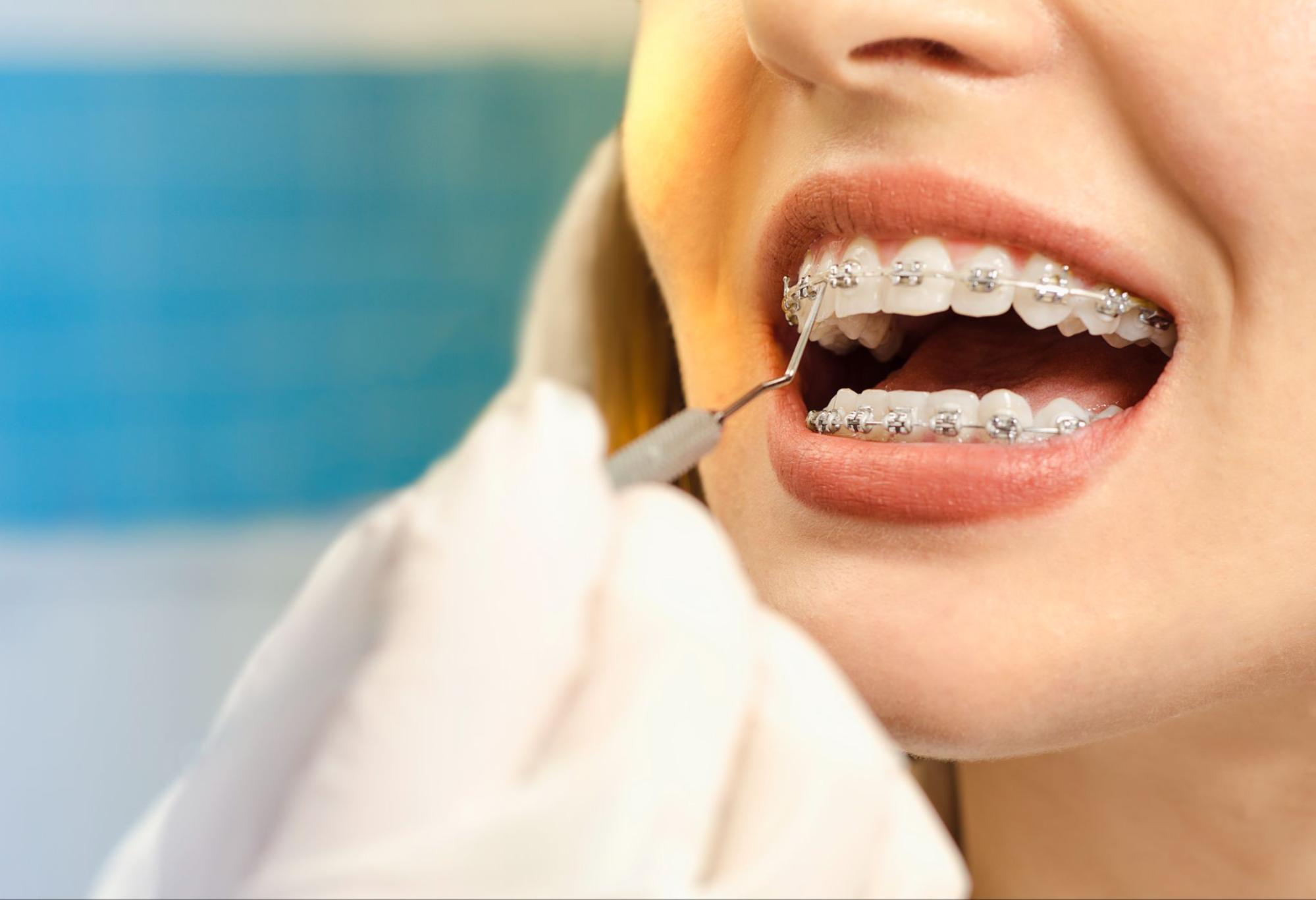 Your Step-by-Step Guide to Starting Orthodontic Treatment